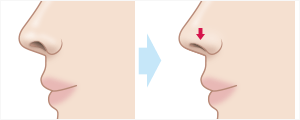 鼻孔縁下降術　施術イメージ