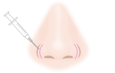 BNLS注射 / VLS注射 施術イメージ